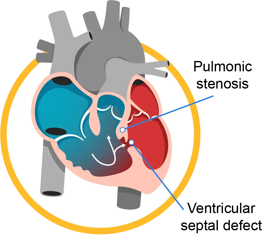 chd-heart