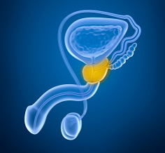 non-bacterial prostatitis with an inflamed prostate gland and no infection in the bladder
